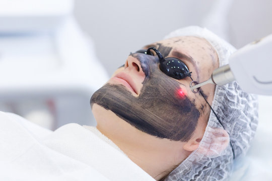 Hollywood_laser_Carbon_Peel_treatment