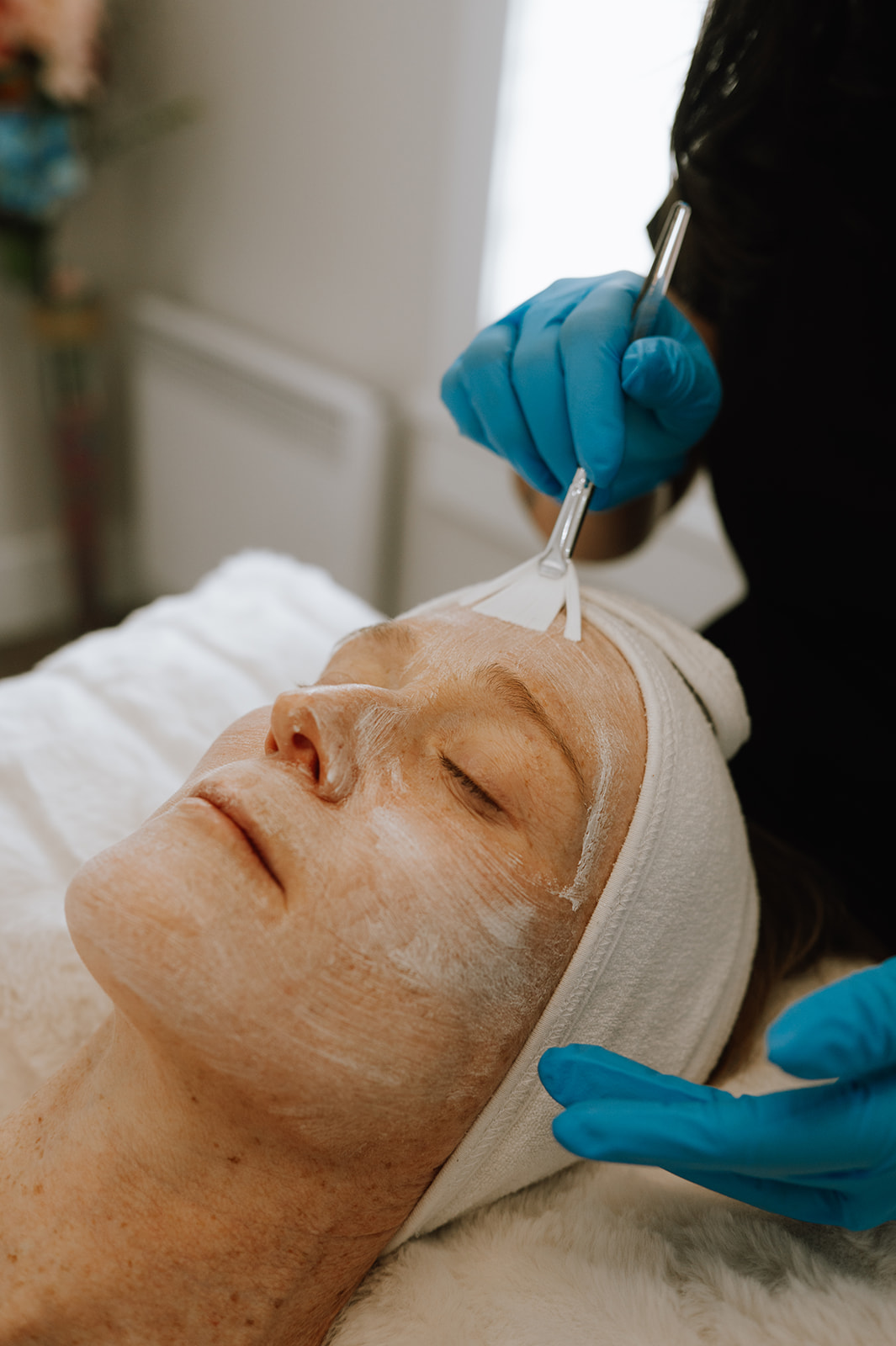 Chemical_Peel_treatment_service_Image