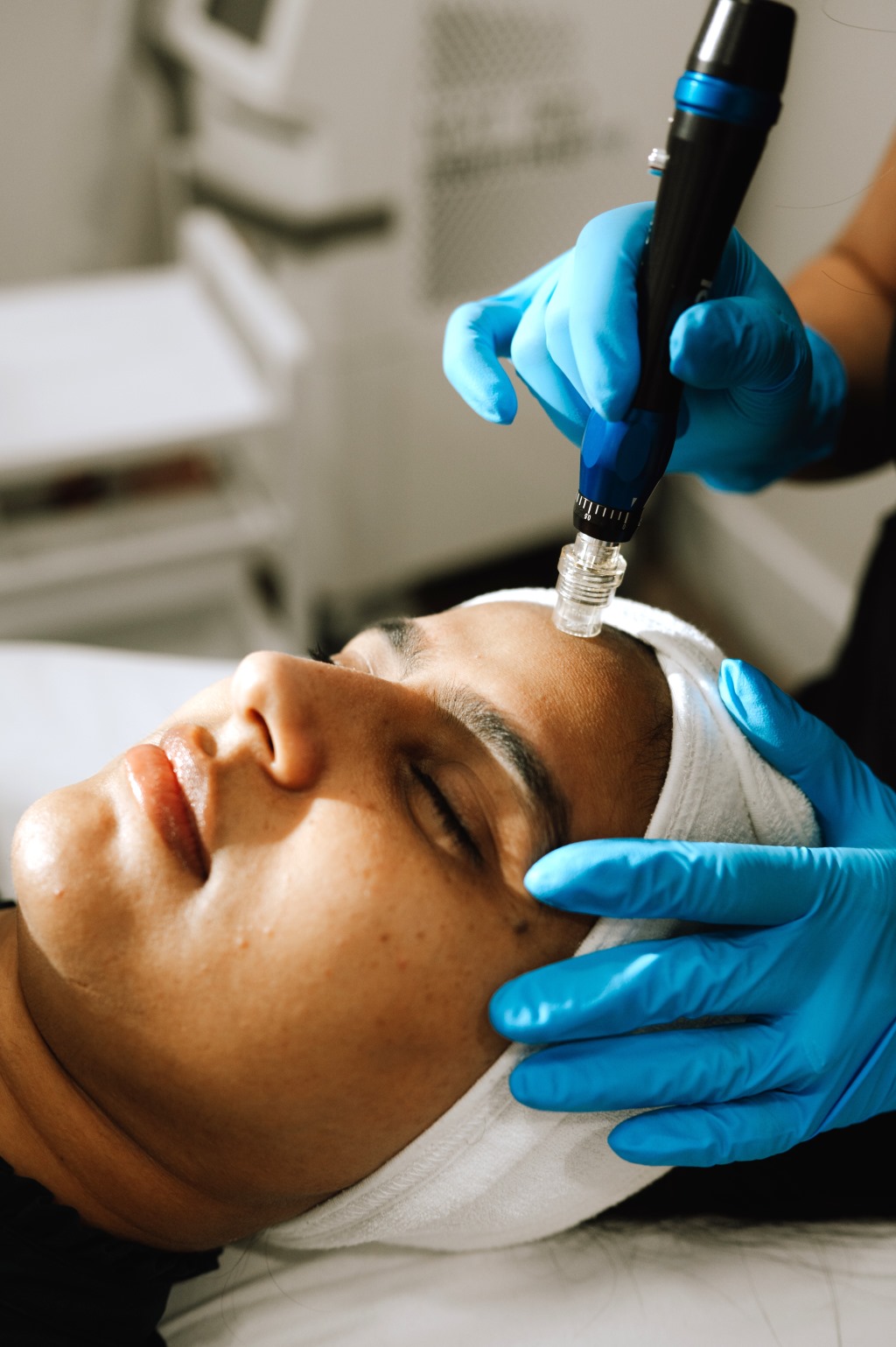 Microneedling_treatment_pic
